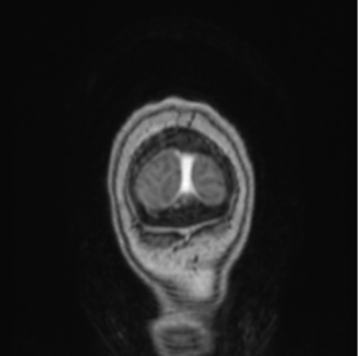 Cerebral abscess from pulmonary arteriovenous malformation (Radiopaedia 86275-102291 L 7).png