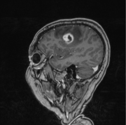 Cerebral abscess from pulmonary arteriovenous malformation (Radiopaedia 86275-102291 Sagittal T1 C+ 59).png