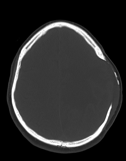 Cerebral abscesses (Radiopaedia 70458-80568 Axial bone window 44).jpg