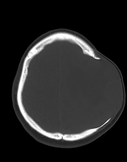 Cerebral abscesses (Radiopaedia 70458-80568 Axial bone window 48).jpg