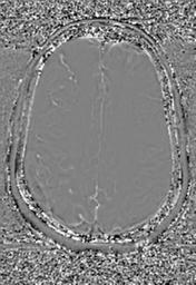 File:Cerebral amyloid angiopathy (Radiopaedia 29129-29518 Axial SWI Phase 26).jpg