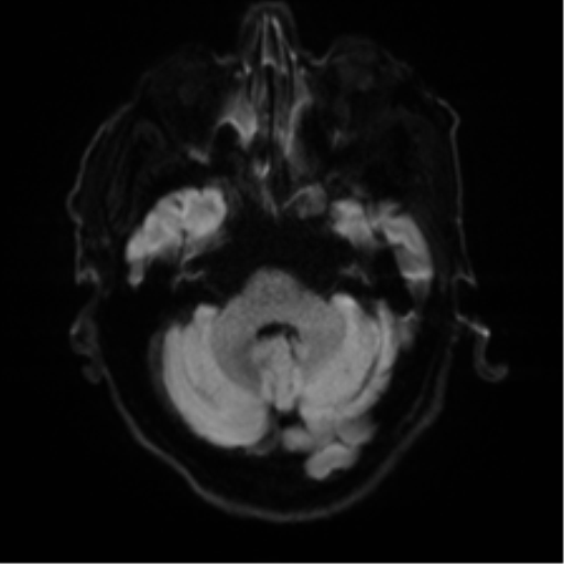 Cerebral amyloid angiopathy (Radiopaedia 46082-50433 Axial DWI 33).png