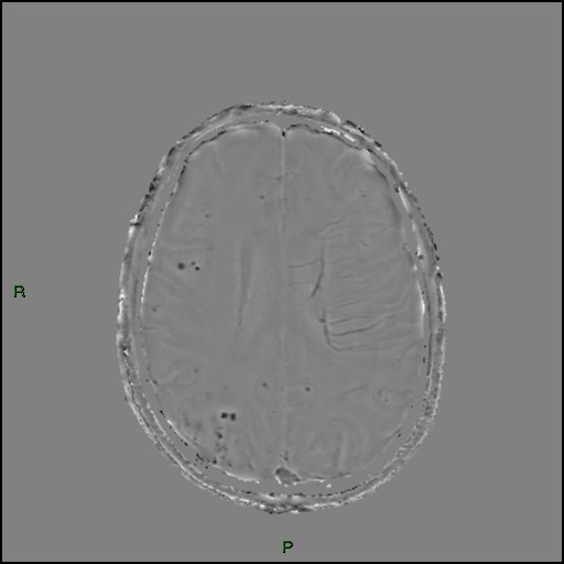 Cerebral amyloid angiopathy (Radiopaedia 77506-89664 H 67).jpg