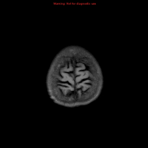 File:Cerebral and orbital tuberculomas (Radiopaedia 13308-13311 Axial T1 20).jpg