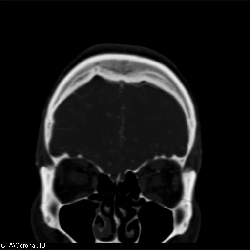 File:Cerebral arteriovenous malformation (Radiopaedia 28518-28759 C 13).jpg