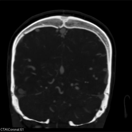 Cerebral arteriovenous malformation (Radiopaedia 28518-28759 C 61).jpg