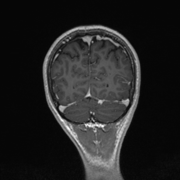 Cerebral arteriovenous malformation (Radiopaedia 30198-30813 F 48).jpg