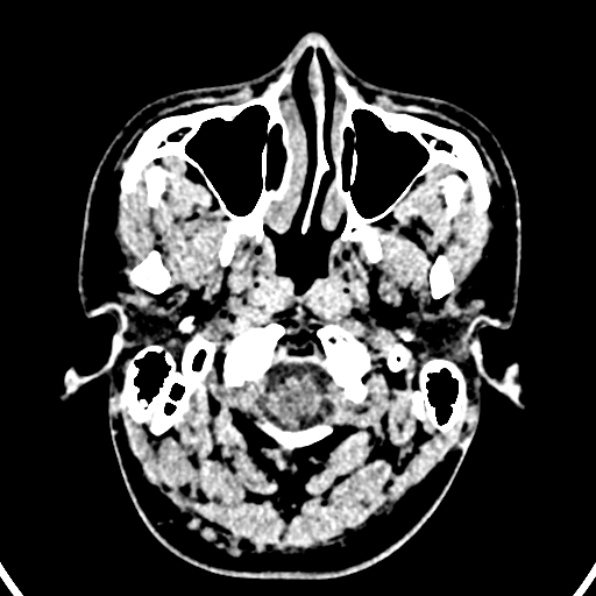 Cerebral arteriovenous malformation (Radiopaedia 37182-39012 Axial non-contrast 1).jpg