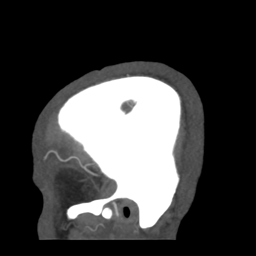 Cerebral arteriovenous malformation (Radiopaedia 39259-41505 Sagittal 6).png