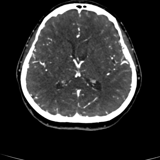 Cerebral arteriovenous malformation (Radiopaedia 73830-84645 Axial C+ delayed 42).jpg