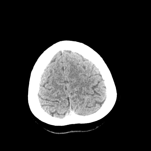 File:Cerebral arteriovenous malformation (Radiopaedia 73830-84645 Axial non-contrast 40).jpg