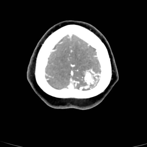 Cerebral arteriovenous malformation (Radiopaedia 73830-84645 B 11).jpg