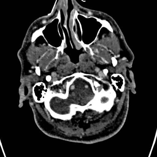 Cerebral arteriovenous malformation (Radiopaedia 78188-90746 Axial C+ delayed 17).jpg