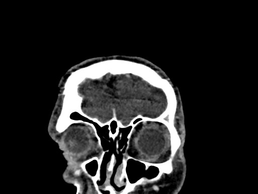 Cerebral arteriovenous malformation (Radiopaedia 78188-90746 Coronal C+ delayed 4).jpg