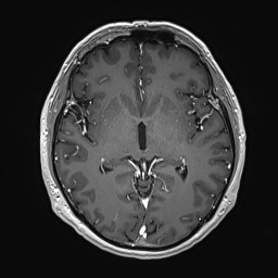 Cerebral arteriovenous malformation (Radiopaedia 84015-99245 Axial T1 C+ 77).jpg