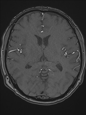 Cerebral arteriovenous malformation (Radiopaedia 84015-99245 Axial TOF 132).jpg