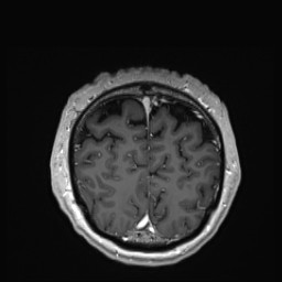 Cerebral arteriovenous malformation (Radiopaedia 84015-99245 Coronal T1 C+ 145).jpg