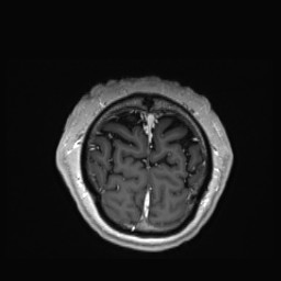 Cerebral arteriovenous malformation (Radiopaedia 84015-99245 Coronal T1 C+ 157).jpg