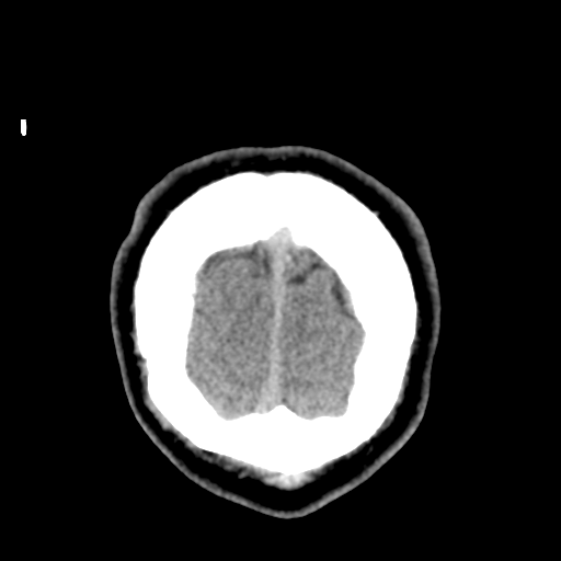 Cerebral arteriovenous malformation (Spetzler-Martin grade 2) (Radiopaedia 41262-44076 Coronal non-contrast 62).png