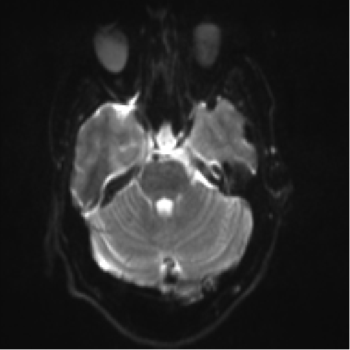 File:Cerebral arteriovenous malformation - huge (Radiopaedia 35734-37272 Axial DWI 7).png