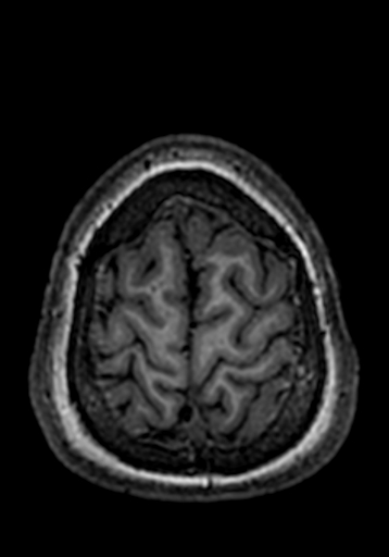 Cerebral arteriovenous malformation at posterior body of corpus callosum (Radiopaedia 74111-84925 Axial T1 19).jpg