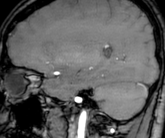 Cerebral arteriovenous malformation at posterior body of corpus callosum (Radiopaedia 74111-84925 J 113).jpg