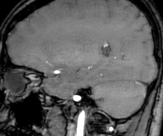 Cerebral arteriovenous malformation at posterior body of corpus callosum (Radiopaedia 74111-84925 J 115).jpg