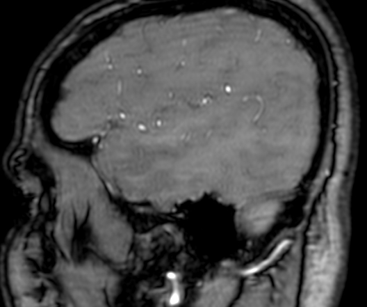 Cerebral arteriovenous malformation at posterior body of corpus callosum (Radiopaedia 74111-84925 J 47).jpg