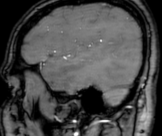 Cerebral arteriovenous malformation at posterior body of corpus callosum (Radiopaedia 74111-84925 J 53).jpg