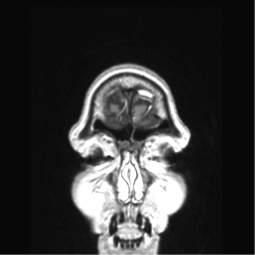 Cerebral arteriovenous malformation with hemorrhage (Radiopaedia 34422-35737 Coronal T1 C+ 87).png