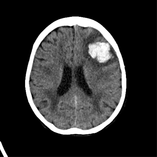 File:Cerebral arteriovenous malformation with lobar hemorrhage (Radiopaedia 44725-48510 Axial non-contrast 26).png