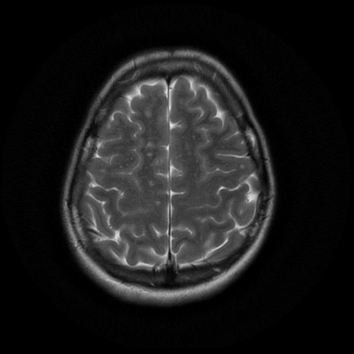 File:Cerebral autosomal dominant arteriopathy with subcortical infarcts and leukoencephalopathy (CADASIL) (Radiopaedia 41018-43763 Ax T2 PROP 16).png