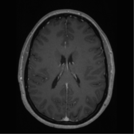 Cerebral cavernoma and development venous anomaly (Radiopaedia 37603-39482 Axial T1 C+ 46).png