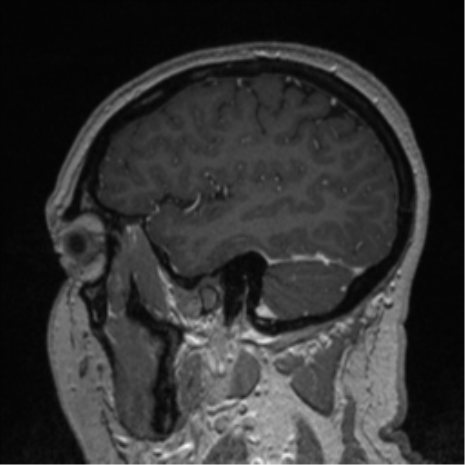 Cerebral cavernoma and development venous anomaly (Radiopaedia 37603-39482 Sagittal T1 C+ 24).png