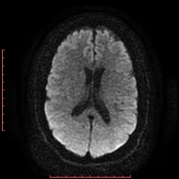 File:Cerebral cavernous malformation (Radiopaedia 26177-26306 Axial DWI 13).jpg