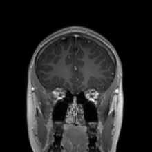 Cerebral cavernous venous malformation (Radiopaedia 70008-80021 Coronal T1 C+ 47).jpg