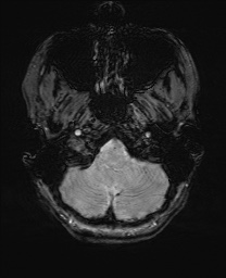 Cerebral cavernous venous malformation (Radiopaedia 70008-80021 I 8).jpg