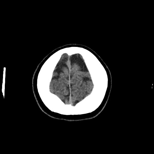 File:Cerebral cavernous venous malformation (Radiopaedia 70008-80022 Axial non-contrast 51).jpg