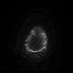Cerebral cavernous venous malformation (Zabramski type II) (Radiopaedia 85511-101198 Axial DWI 32).jpg