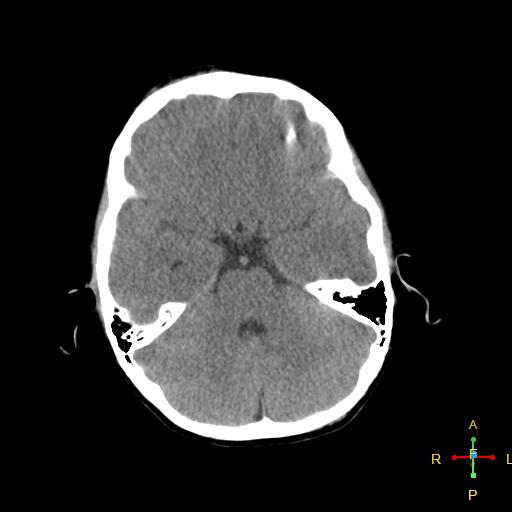 File:Cerebral contusion (Radiopaedia 48869-53911 Axial non-contrast 5).jpg