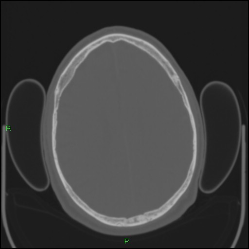 Cerebral contusions (Radiopaedia 33868-35039 Axial bone window 146).jpg