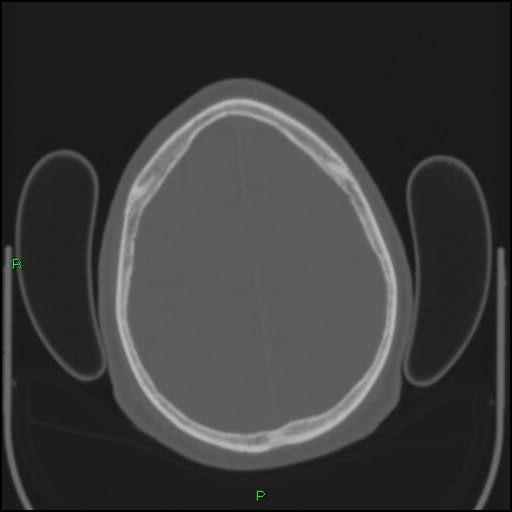 Cerebral contusions (Radiopaedia 33868-35039 Axial bone window 168).jpg