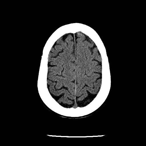 Cerebral edema (evolution in time) (Radiopaedia 19418-19441 non-contrast 76).jpg