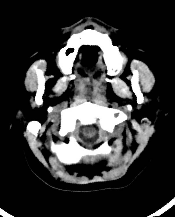 Cerebral edema due to severe hyponatremia (Radiopaedia 89826-106938 Axial non-contrast 8).jpg