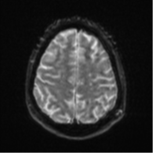 File:Cerebral embolic infarcts (embolic shower) (Radiopaedia 57395-64342 Axial DWI 28).png