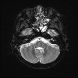 Cerebral embolic infarcts (embolic shower) (Radiopaedia 72391-82921 Axial DWI 6).jpg