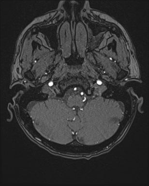Cerebral embolic infarcts (embolic shower) (Radiopaedia 72391-82921 Axial MRA 2).jpg