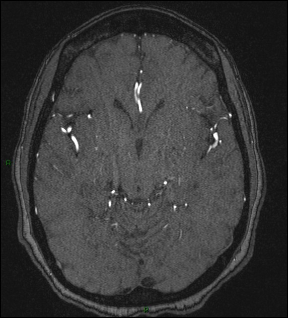 Cerebral fat embolism (Radiopaedia 35022-36525 Axial TOF 91).jpg