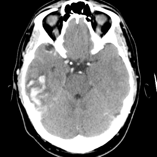 Cerebral hemorrhage secondary to arteriovenous malformation (Radiopaedia 33497-34561 B 19).png