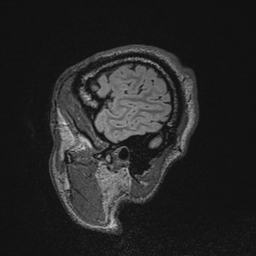 File:Cerebral hemorrhagic contusions- temporal evolution (Radiopaedia 40224-42757 Sagittal T1 11).png